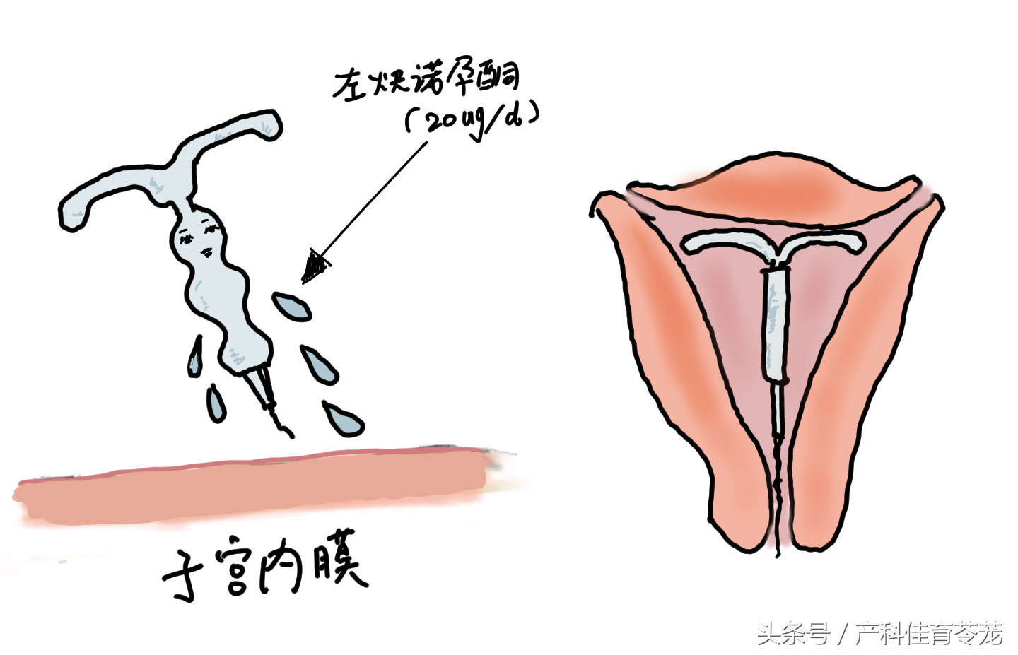 上曼月乐环之前，您必须了解可能会这样……