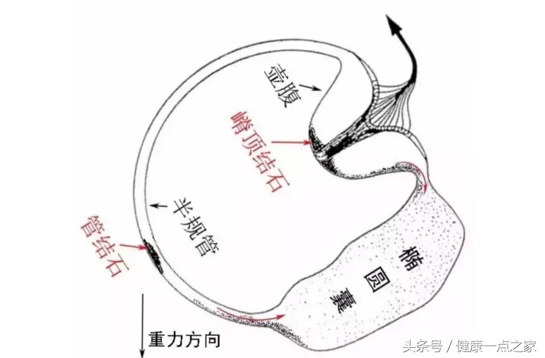 图1耳石症可分为半规管耳石症(或称管结石)和壶腹耳石症(或称嵴顶结石