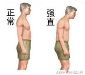 强直性脊柱炎的确诊方法与诊断标准