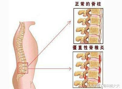 如何确诊强直性脊柱炎？