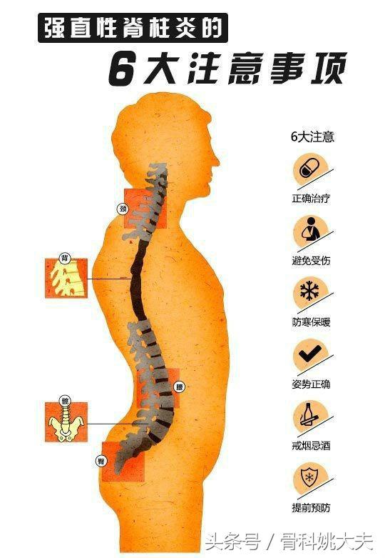 如何确诊强直性脊柱炎？