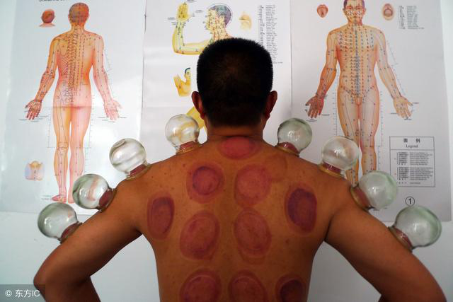 拔罐真的可以排毒吗？拔出的水泡是体内毒素？1篇文章为你说清楚