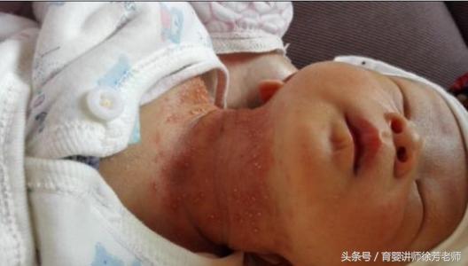 婴幼儿痱子湿疹傻傻分不清，别怕，5点来分辨，妈妈们来收藏！