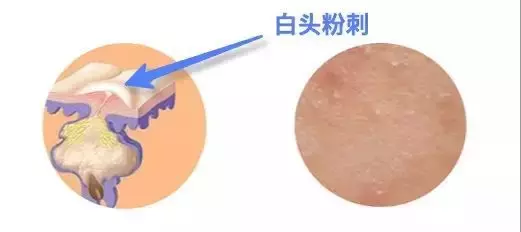 闭口粉刺怎么有效去除？实用方法大揭秘