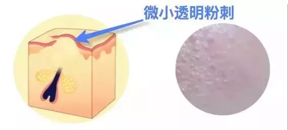 你也有“闭口”噩梦吗?手把手教你去除烦人的闭口!