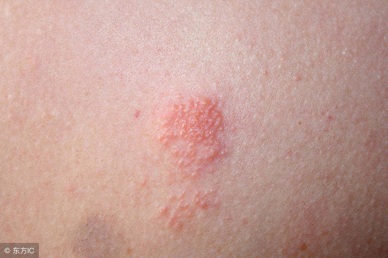 玫瑰糠疹是一种很常见的皮肤病过敏现象,对于皮肤性疾病肯定要注意