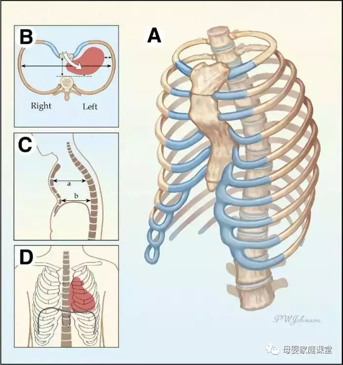 先天性胸壁瘘管图片