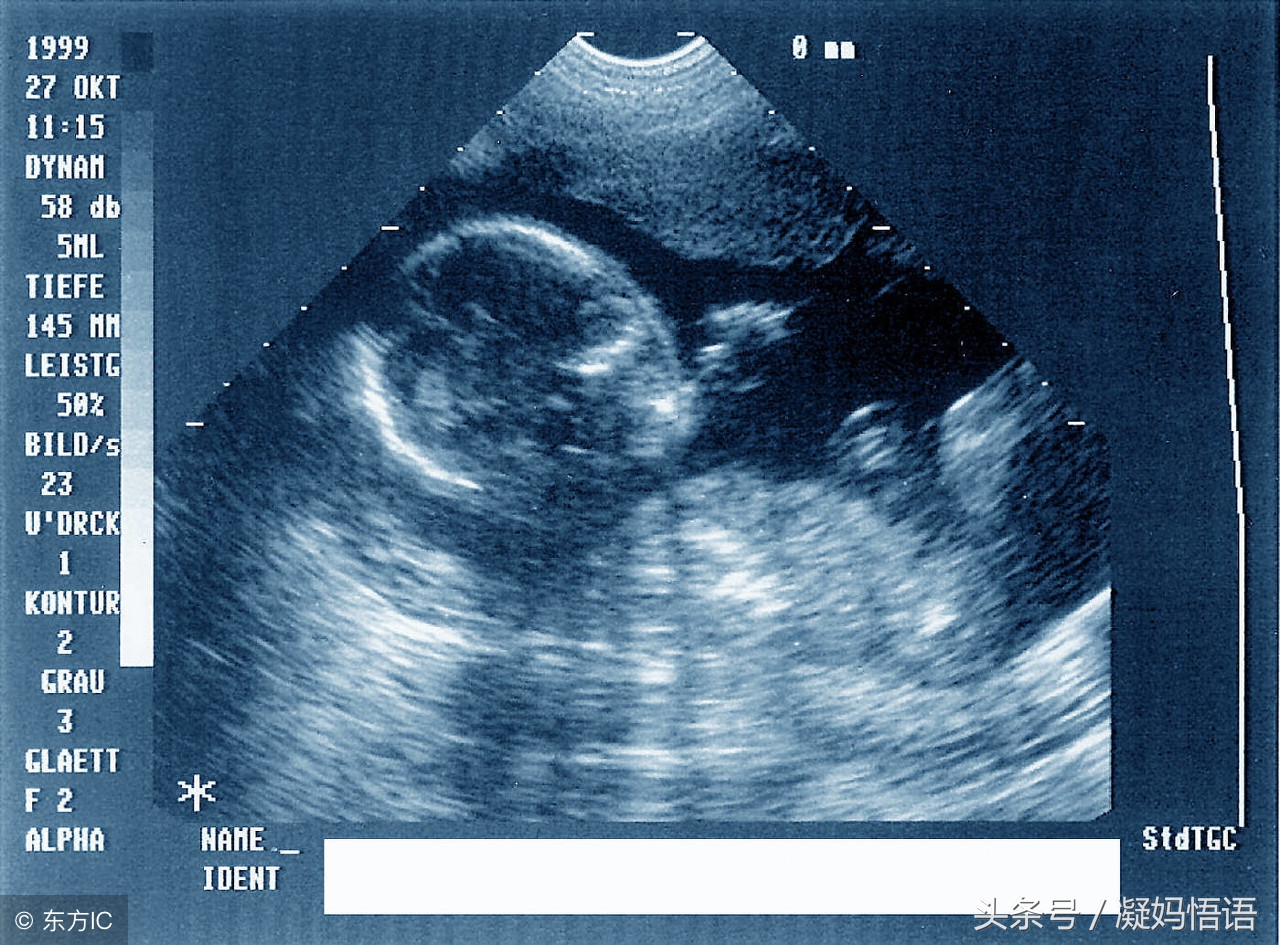 胎儿股骨偏短图片