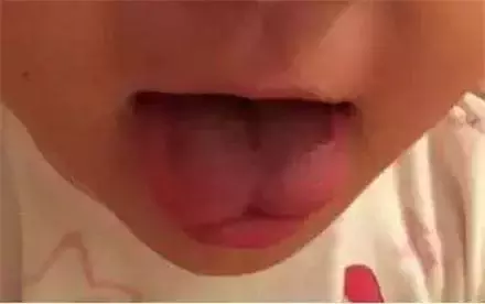 别让这两种系带影响孩子的口腔健康!