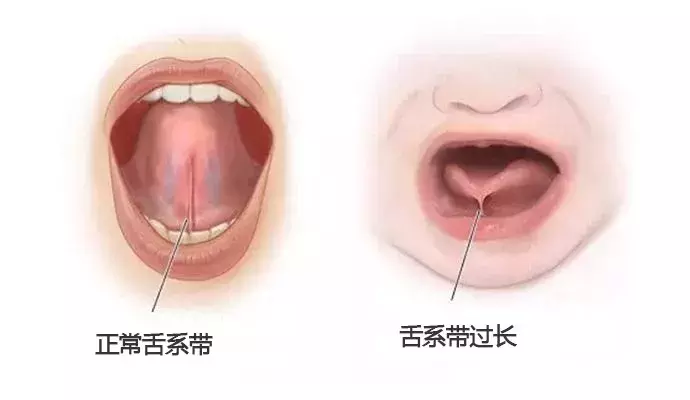 别让这两种系带影响孩子的口腔健康!