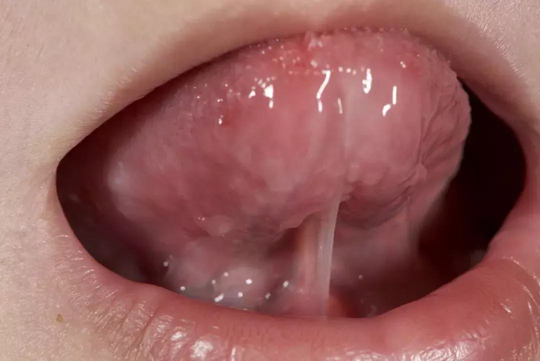 别让这两种系带影响孩子的口腔健康!