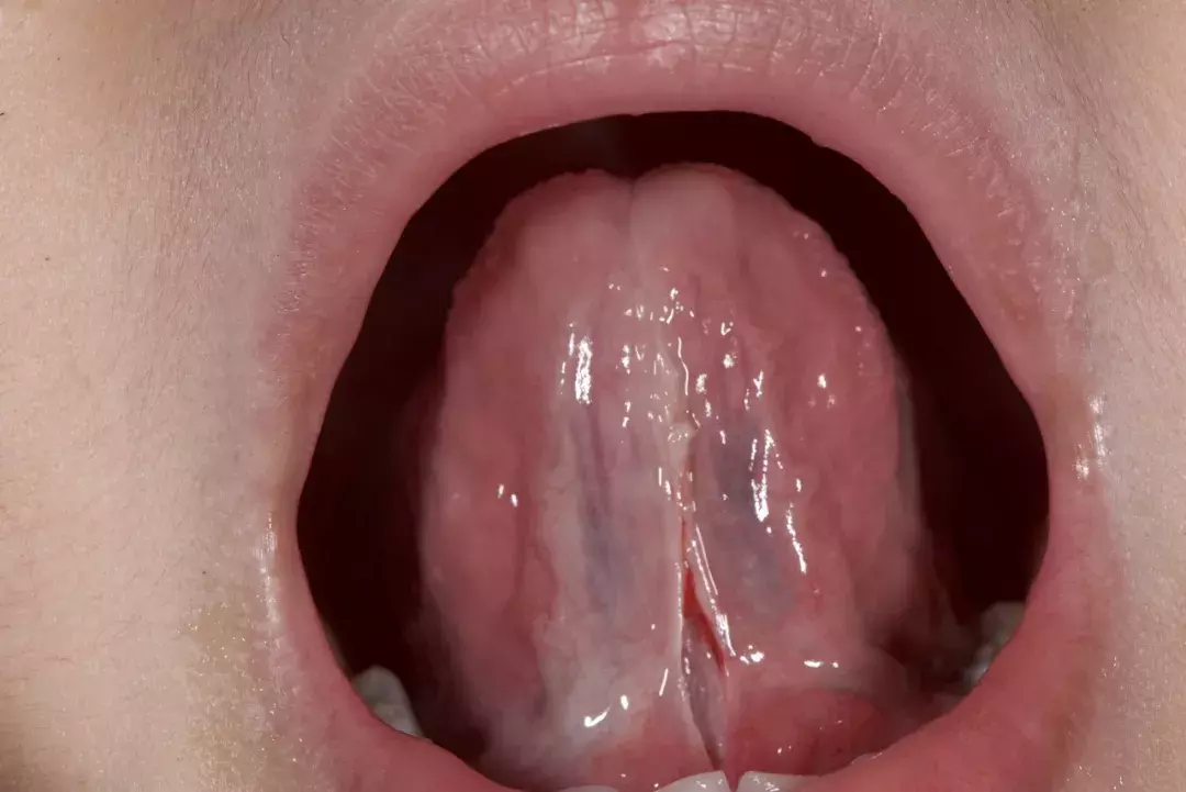别让这两种系带影响孩子的口腔健康!