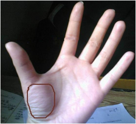 正常人手掌与肝掌图片老中医手诊