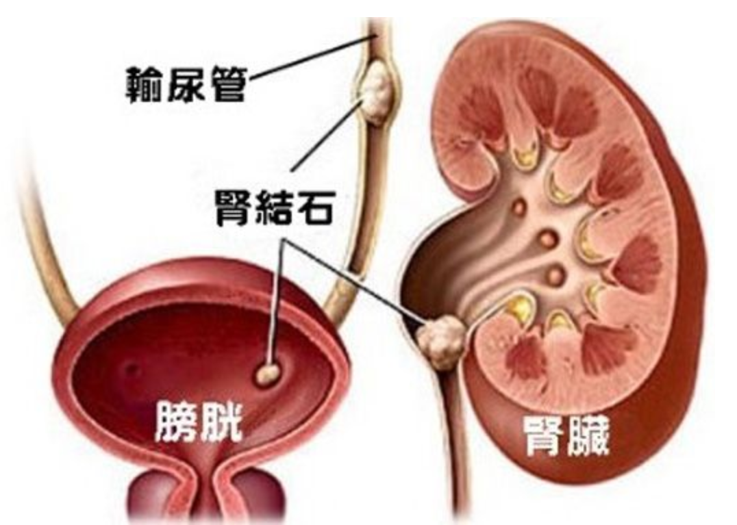 导致泌尿系结石的因素有哪些?