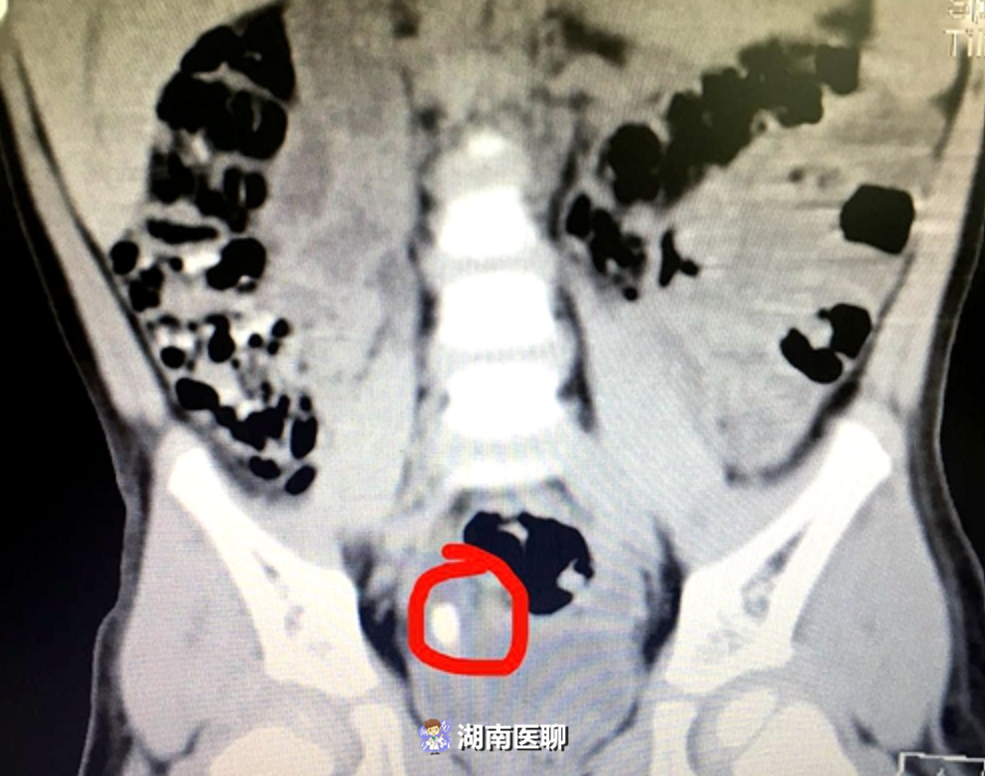 小孩出现血尿什么情况？导致泌尿系结石的因素有哪些？