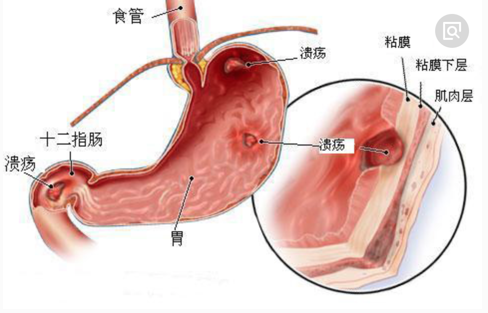 胃的结构图详解，胃糜烂和胃溃疡哪个更严重？