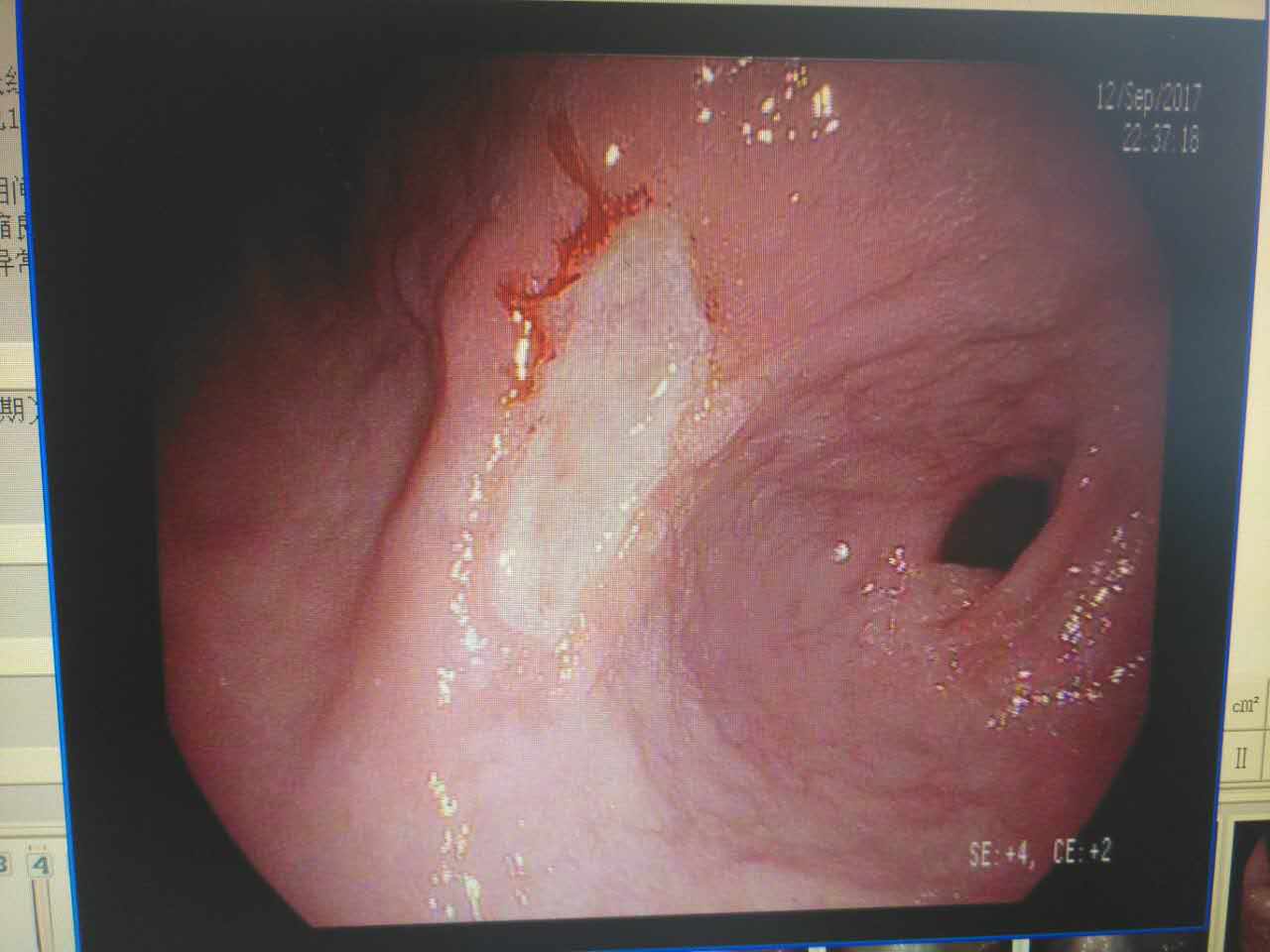 胃镜医生说:胃糜烂和胃溃疡哪个更严重?