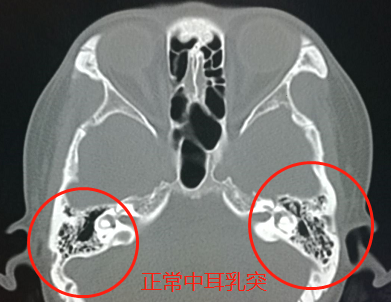 孩子的听力无故下降？中耳炎时怎么得的？如何有效预防？