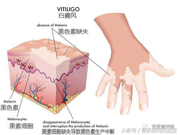 宝宝身上长白斑不一定是白癜风，很可能是它！