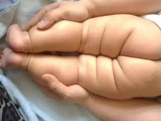 孩子腿纹臀纹不对称就是髋关节发育不良吗？为啥说越早发现越好！