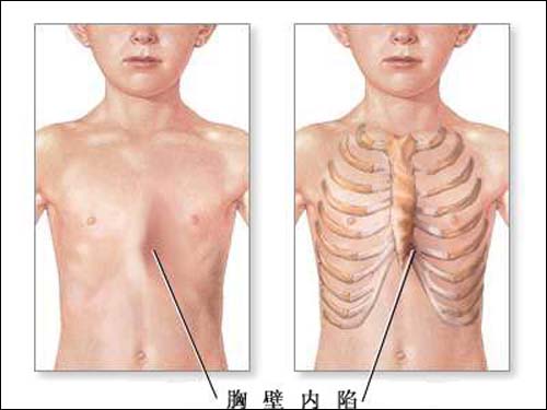 6个月婴儿漏斗胸的图片（孩子长）
