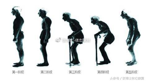 「运动康复科普」强直性脊柱炎了解一下，康复训练方法请看文章