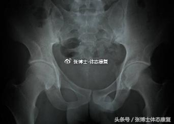 「运动康复科普」强直性脊柱炎了解一下，康复训练方法请看文章