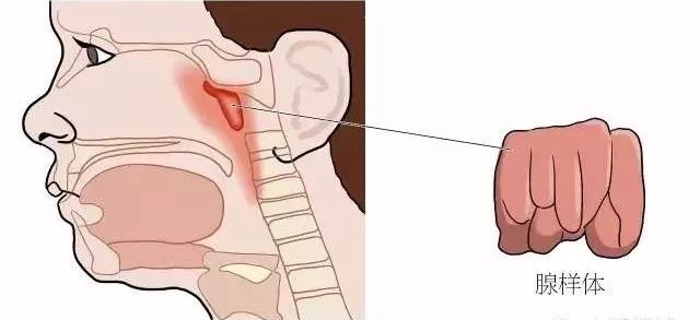 腺樣體肥大手術價格腺樣體肥大到底要不要做手術