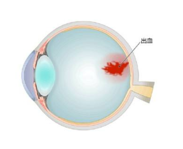 小伙眼球被“肘击”视力模糊，玻璃体出血只能手术治疗吗？
