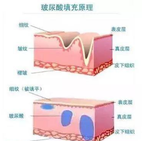 王菲500万天价打的童颜针，真的可以返老还童吗？