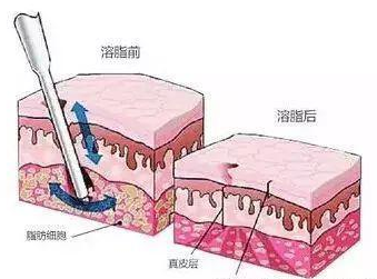 王菲500万天价打的童颜针，真的可以返老还童吗？