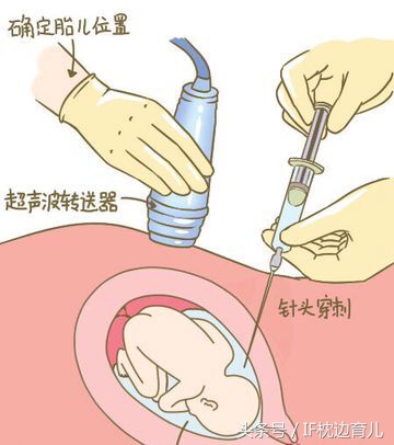 二胎孕期唐筛高危怎么办？这两个检查孕妈不要落下了！