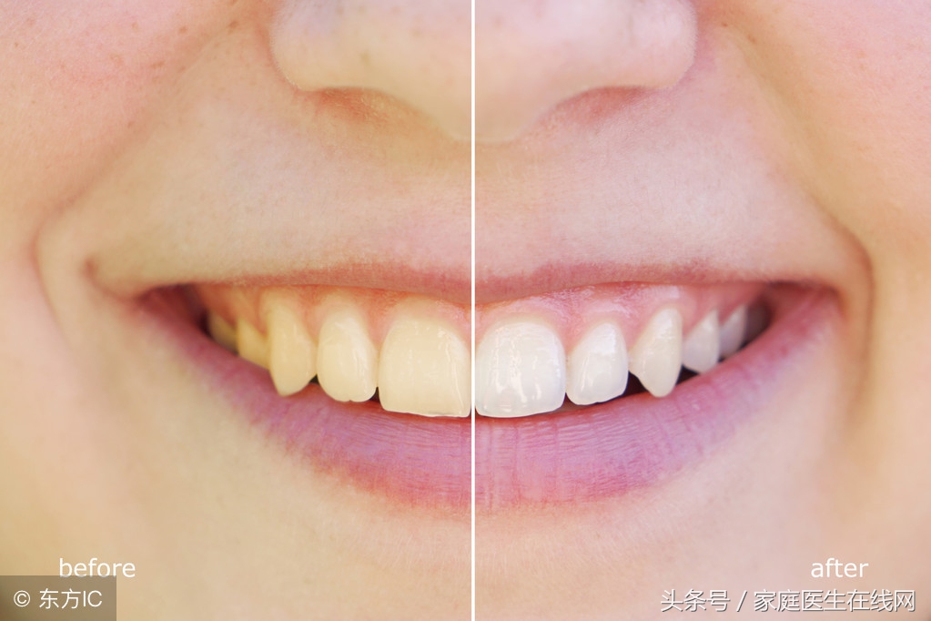 牙齒鈣化是怎麽回事（牙齒天天刷）