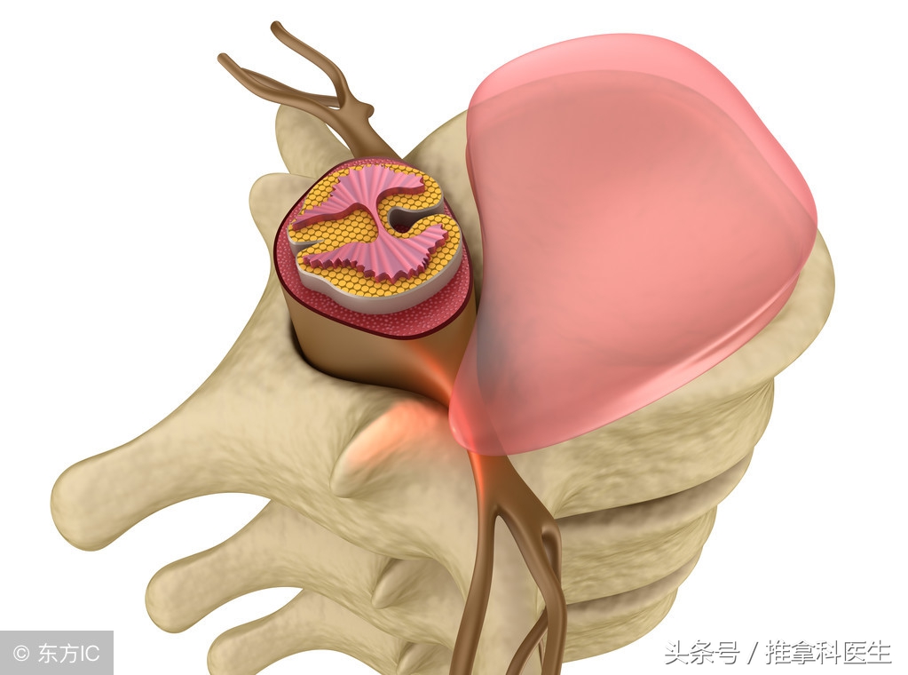 腰突三：你知道腰椎间盘突出症的微创手术都有哪些吗？