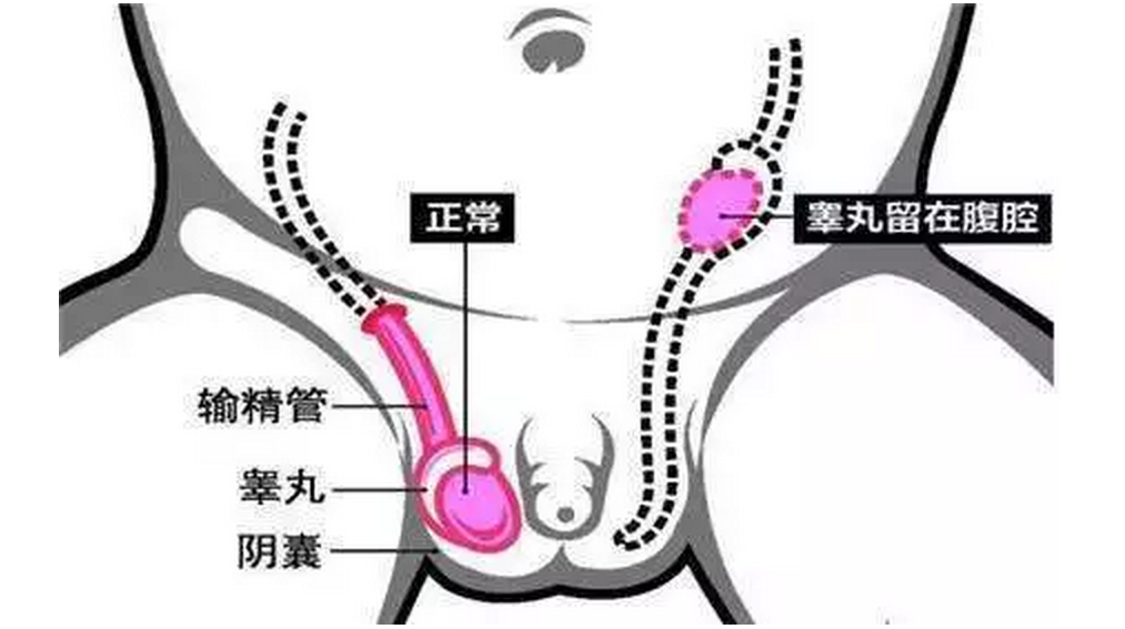 2岁宝宝先天睾丸“错位”，医生腹腔镜下手术送它“回家”