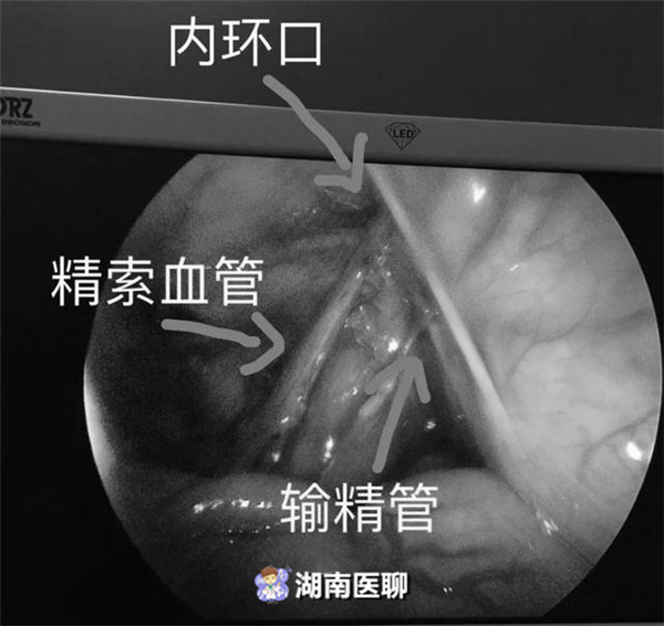 2岁宝宝先天睾丸“错位”，医生腹腔镜下手术送它“回家”