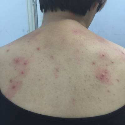 后背抠下脂肪粒,暗示百万螨虫在后背"为非作歹",记住3招灭螨