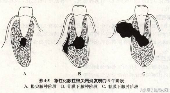 全国爱牙日｜牙龈脓包怎么办？
