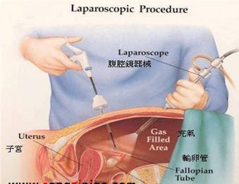 为什么腹腔镜微创手术要全身麻醉？是不是为了多收钱？真相是什么