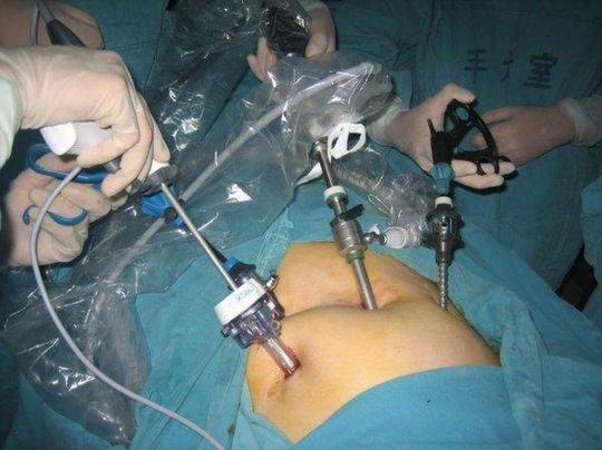 为什么腹腔镜微创手术要全身麻醉？是不是为了多收钱？真相是什么