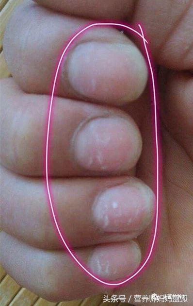指甲长长就会消失;2,其他情况可能是有蛔虫或者肠胃病,影响了营养吸收