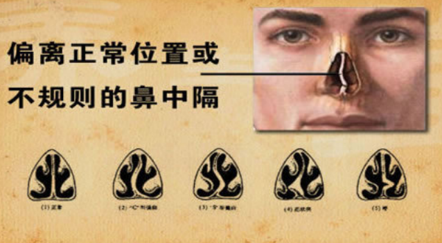 反复鼻塞流涕且鼻涕带血是怎么回事？