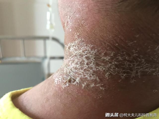 此种儿童皮肤感染疾病,若不积极治疗,容易导致严重败血症,切记