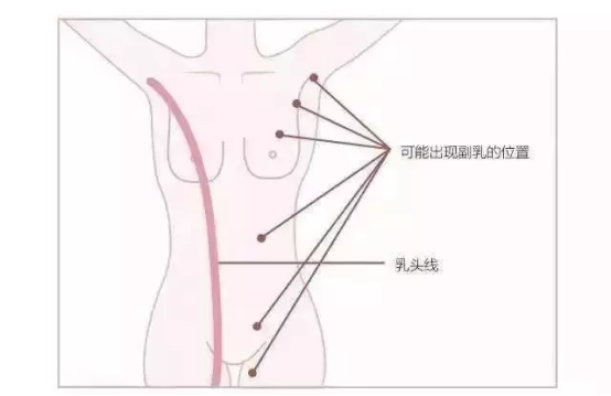 怎么区分真副乳和假副乳 怎么消除副乳的方法