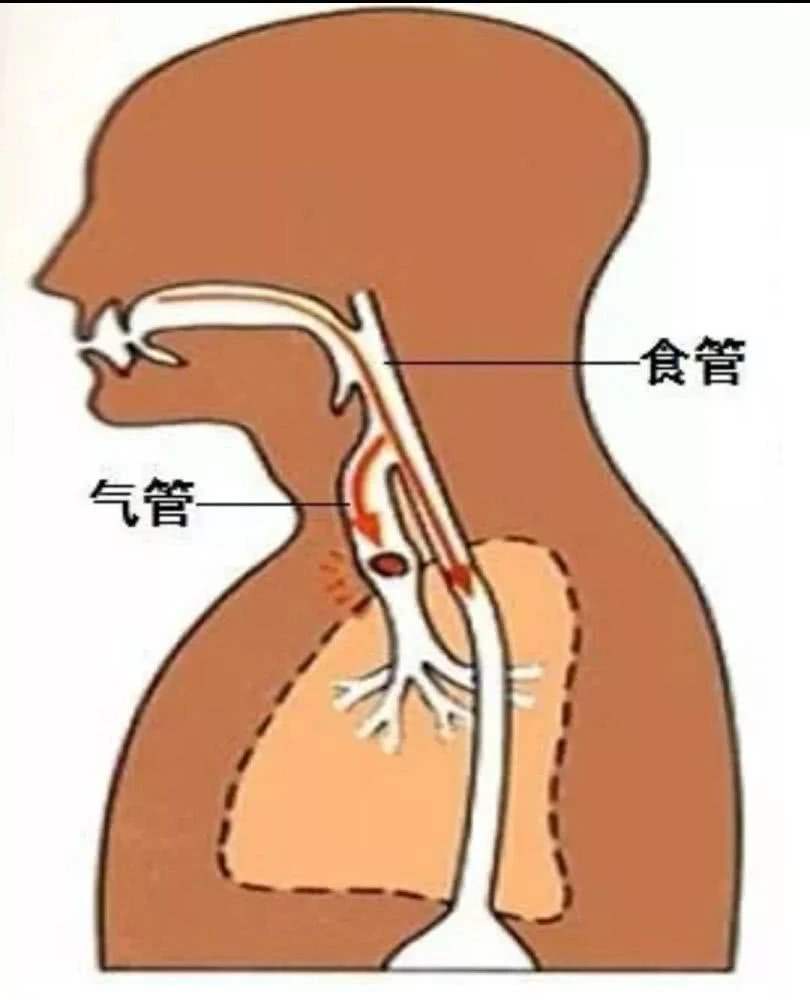 胃镜检查前喝的药是什么？了解它，对于能否顺利完成检查至关重要