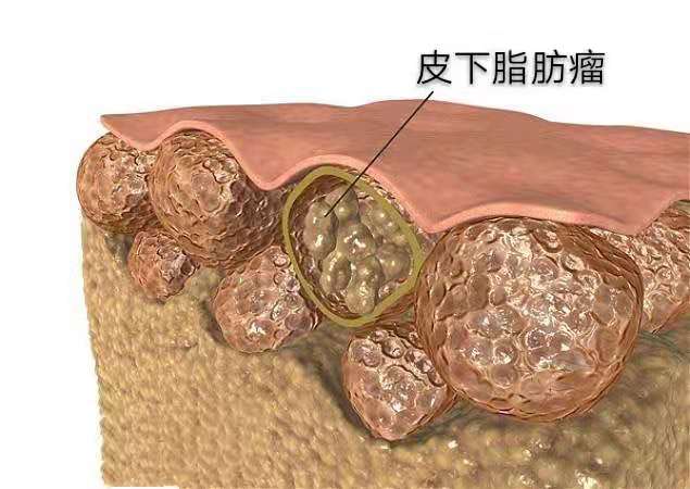 皮下脂肪瘤形成原因是什麼?會癌變嗎?