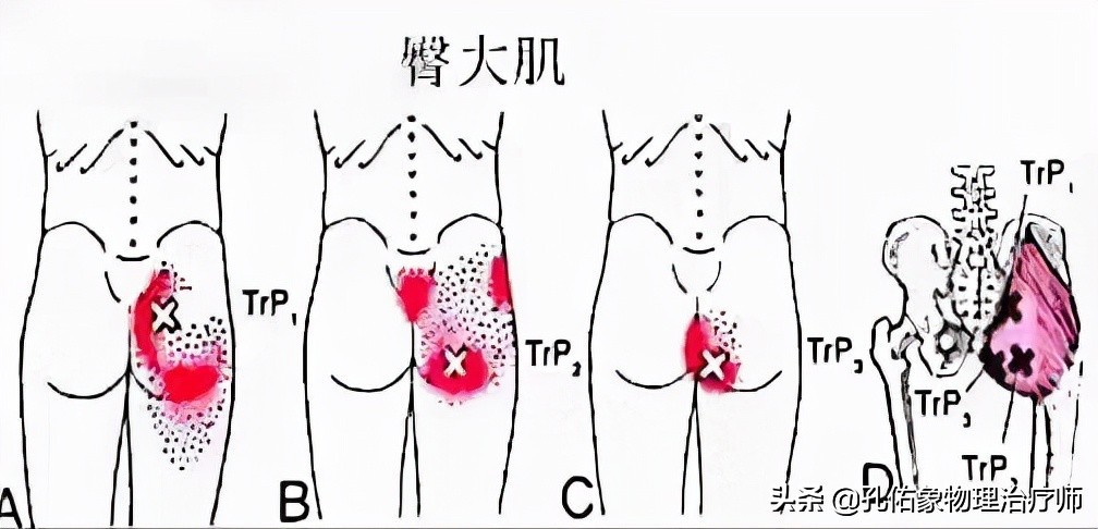 腰臀部疼或下肢麻木，是腰椎间盘突出吗？9种疾病需鉴别