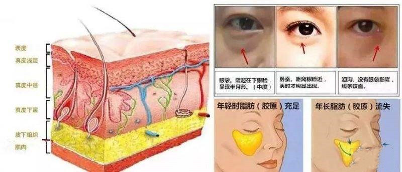 生姜可以去除眼袋吗 加点它三天就见效