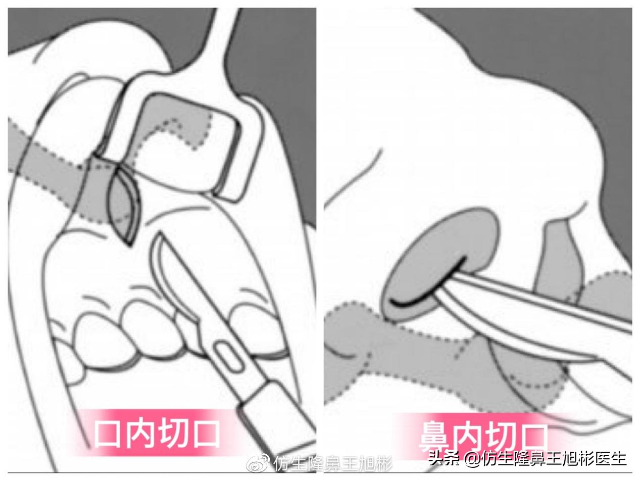 玻尿酸、脂肪、肋软骨、膨体、硅胶、人工骨…哪种鼻基底填充材好