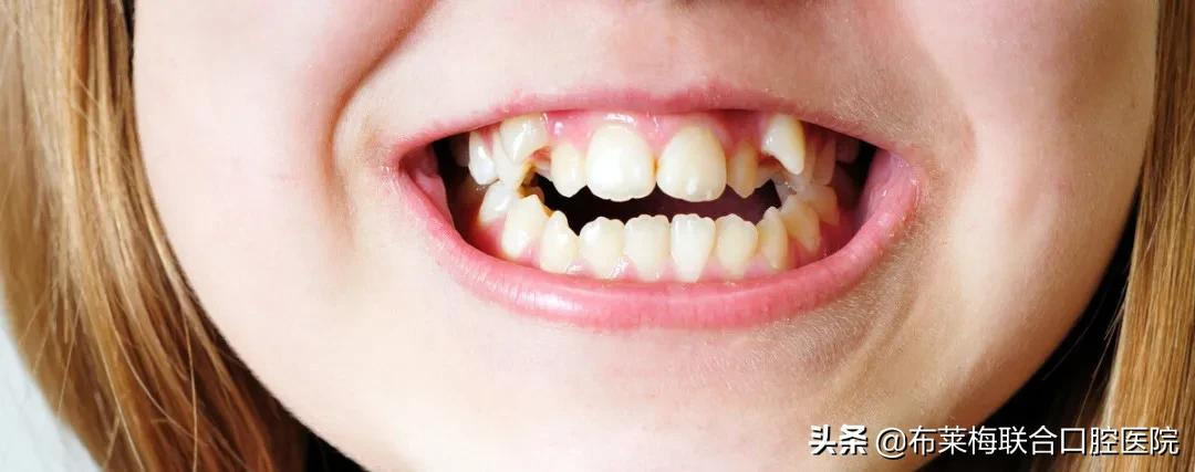 牙齿矫正,你所关心的那些问题